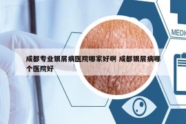 成都專業(yè)銀屑病醫(yī)院哪家好啊 成都銀屑病哪個醫(yī)院好