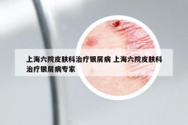 上海六院皮膚科治療銀屑病 上海六院皮膚科治療銀屑病專家