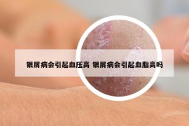 銀屑病會(huì)引起血壓高 銀屑病會(huì)引起血脂高嗎