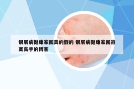銀屑病健康家園真的假的 銀屑病健康家園寂寞高手的博客