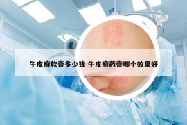 牛皮癬軟膏多少錢 牛皮癬藥膏哪個效果好