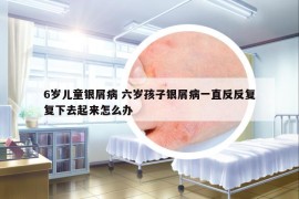 6歲兒童銀屑病 六歲孩子銀屑病一直反反復復下去起來怎么辦