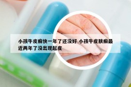 小孩牛皮癬快一年了還沒(méi)好 小孩牛皮膚癬最近兩年了沒(méi)出現(xiàn)起皮