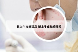 腿上牛皮癬禁忌 腿上牛皮膚癬圖片