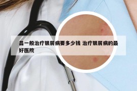昌一般治療銀屑病要多少錢 治療銀屑病的最好醫(yī)院