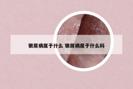 銀屑病屬于什么 銀屑病屬于什么科