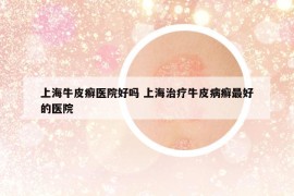 上海牛皮癬醫(yī)院好嗎 上海治療牛皮病癬最好的醫(yī)院