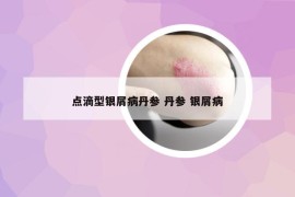 點(diǎn)滴型銀屑病丹參 丹參 銀屑病