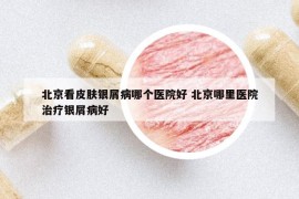 北京看皮膚銀屑病哪個(gè)醫(yī)院好 北京哪里醫(yī)院治療銀屑病好