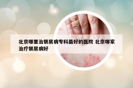 北京哪里治銀屑病?？谱詈玫尼t(yī)院 北京哪家治療銀屑病好
