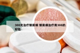 308光治療銀屑病 銀屑病治療用308的好處