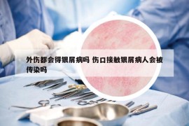 外傷都會得銀屑病嗎 傷口接觸銀屑病人會被傳染嗎