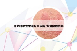 什么樹根煮水治療牛皮癬 專治樹根的藥