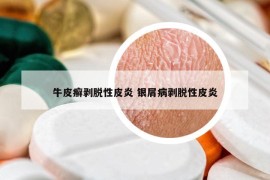 牛皮癬剝脫性皮炎 銀屑病剝脫性皮炎