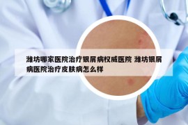 濰坊哪家醫(yī)院治療銀屑病權(quán)威醫(yī)院 濰坊銀屑病醫(yī)院治療皮膚病怎么樣
