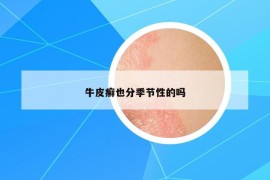 牛皮癬也分季節(jié)性的嗎