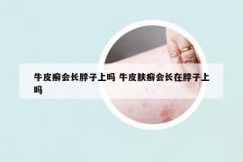 牛皮癬會長脖子上嗎 牛皮膚癬會長在脖子上嗎