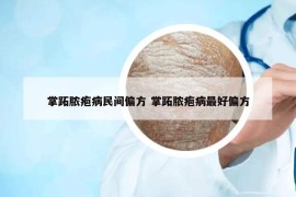 掌跖膿皰病民間偏方 掌跖膿皰病最好偏方