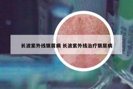 長(zhǎng)波紫外線銀屑病 長(zhǎng)波紫外線治療銀屑病