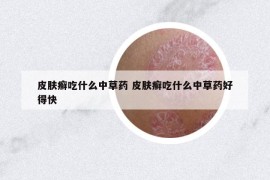 皮膚癬吃什么中草藥 皮膚癬吃什么中草藥好得快