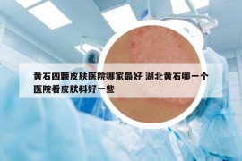 黃石四顆皮膚醫(yī)院哪家最好 湖北黃石哪一個(gè)醫(yī)院看皮膚科好一些