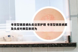 尋常型銀屑病頭皮日常護(hù)理 尋常型銀屑病累及頭皮時(shí)典型表現(xiàn)為