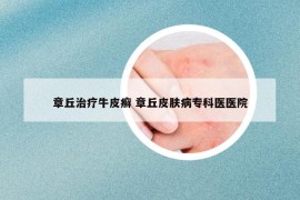 章丘治療牛皮癬 章丘皮膚病?？漆t(yī)醫(yī)院