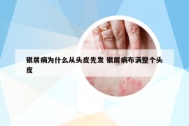 銀屑病為什么從頭皮先發(fā) 銀屑病布滿整個(gè)頭皮