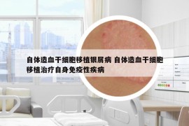 自體造血干細(xì)胞移植銀屑病 自體造血干細(xì)胞移植治療自身免疫性疾病