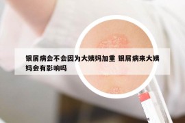 銀屑病會不會因為大姨媽加重 銀屑病來大姨媽會有影響嗎