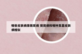 哪些皮膚病像銀屑病 銀屑病和哪種真菌皮膚病相似