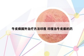 牛皮癬國外治療方法印度 印度治牛皮廨的藥