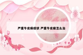 嚴(yán)重牛皮癬癥狀 嚴(yán)重牛皮廨怎么治