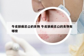 牛皮膚癬忌口的食物 牛皮膚癬忌口的食物有哪些