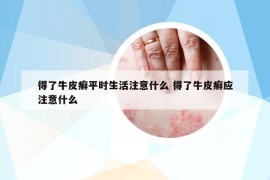 得了牛皮癬平時生活注意什么 得了牛皮癬應(yīng)注意什么