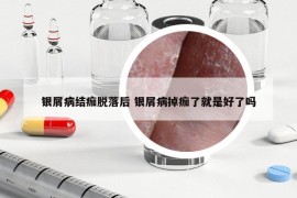 銀屑病結(jié)痂脫落后 銀屑病掉痂了就是好了嗎