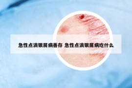 急性點(diǎn)滴銀屑病善存 急性點(diǎn)滴銀屑病吃什么