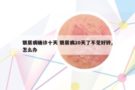 銀屑病確診十天 銀屑病20天了不見好轉(zhuǎn),怎么辦