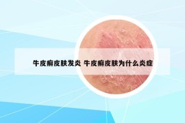 牛皮癬皮膚發(fā)炎 牛皮癬皮膚為什么炎癥