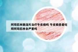 阿司匹林腸溶片治療牛皮癬嗎 牛皮癬患者吃拜阿司匹林會嚴重嗎