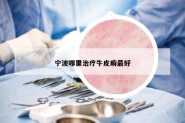 寧波哪里治療牛皮癬最好