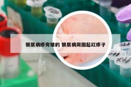 銀屑病疹旁皺的 銀屑病周圍起紅疹子