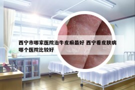 西寧市哪家醫(yī)院治牛皮癬最好 西寧看皮膚病哪個醫(yī)院比較好