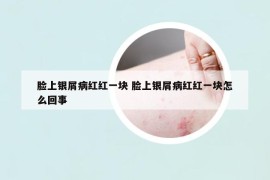 臉上銀屑病紅紅一塊 臉上銀屑病紅紅一塊怎么回事