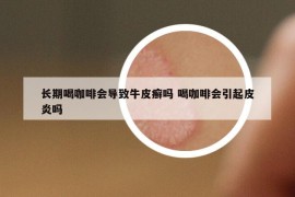 長期喝咖啡會(huì)導(dǎo)致牛皮癬嗎 喝咖啡會(huì)引起皮炎嗎