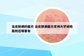 治皮膚病的偏方 治皮膚病偏方常州大學城鳴凰附近哪里有