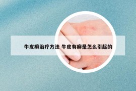 牛皮癬治療方法 牛皮有癬是怎么引起的