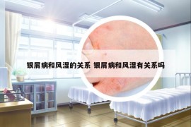 銀屑病和風濕的關系 銀屑病和風濕有關系嗎