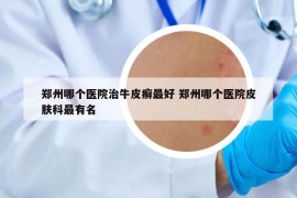 鄭州哪個(gè)醫(yī)院治牛皮癬最好 鄭州哪個(gè)醫(yī)院皮膚科最有名