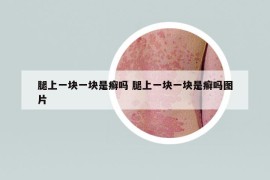 腿上一塊一塊是癬嗎 腿上一塊一塊是癬嗎圖片